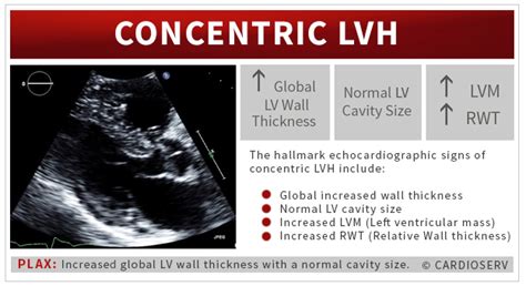 mild concentric lvh treatment.